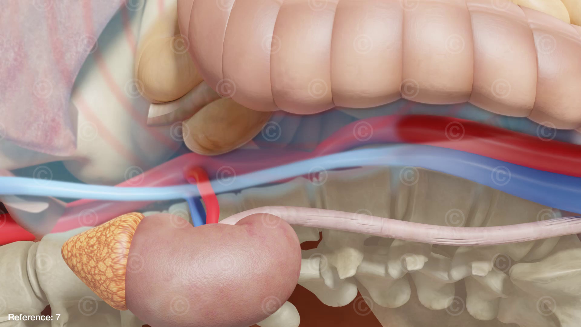 Compression of the vena cava - less blood can be transported through the vein