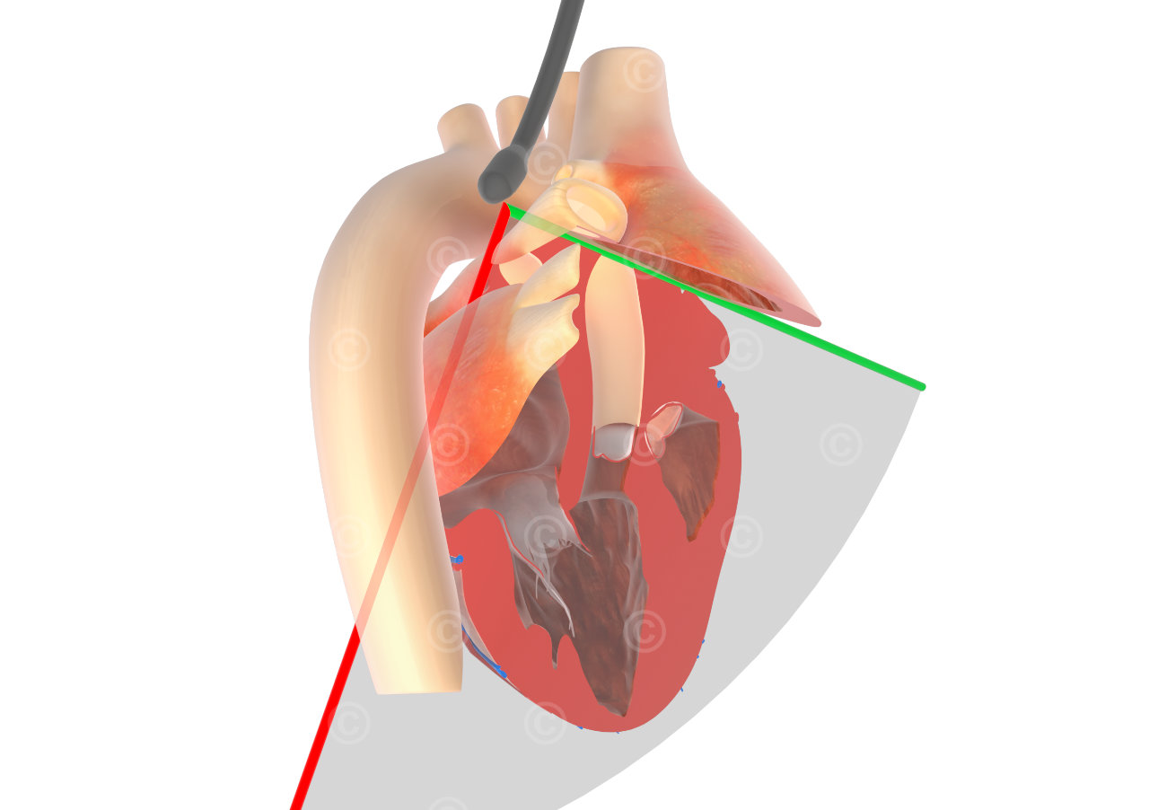 ME-LAX Transesophageal Echocardiography