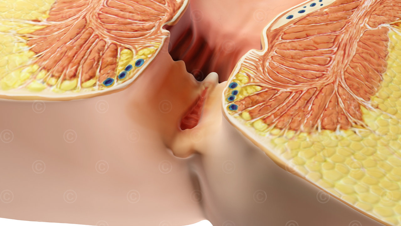 anal fissure sectional view