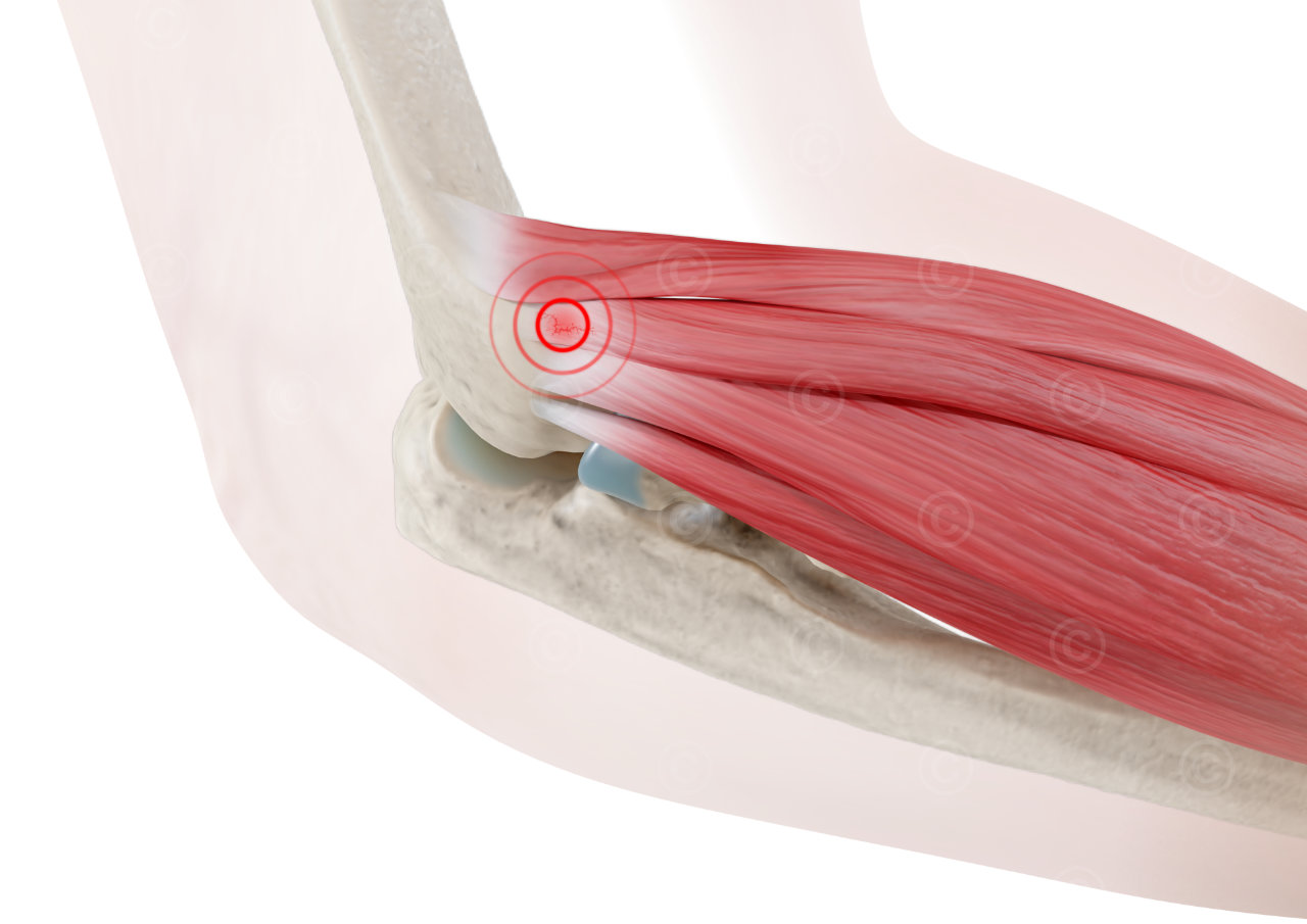 Ellenbogen bei Epicondylitis