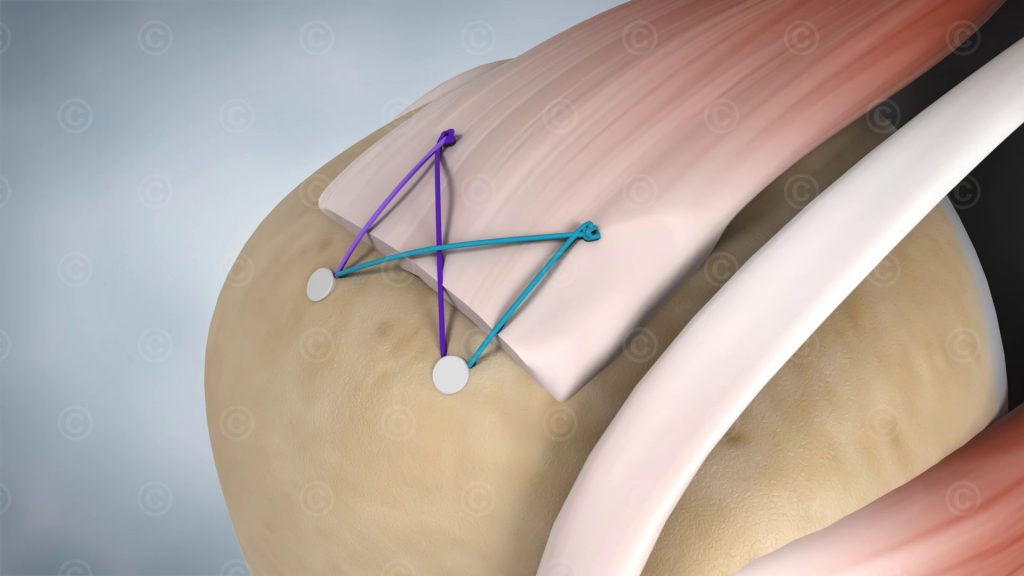 Animation rupture rotator cuff MedicalGraphics
