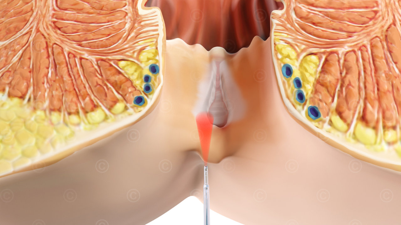 Behandlung Analfissur mittels Laser