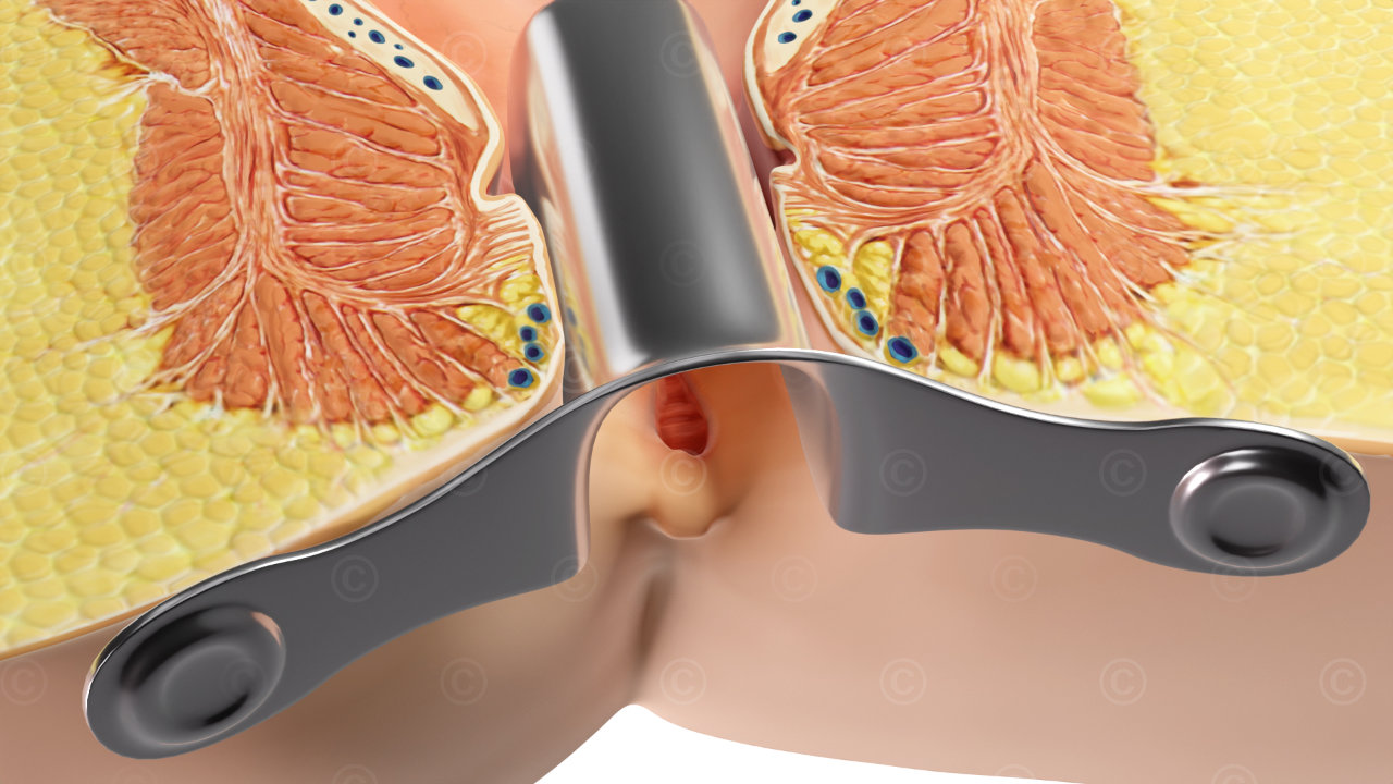 proktoskop operation analfissur