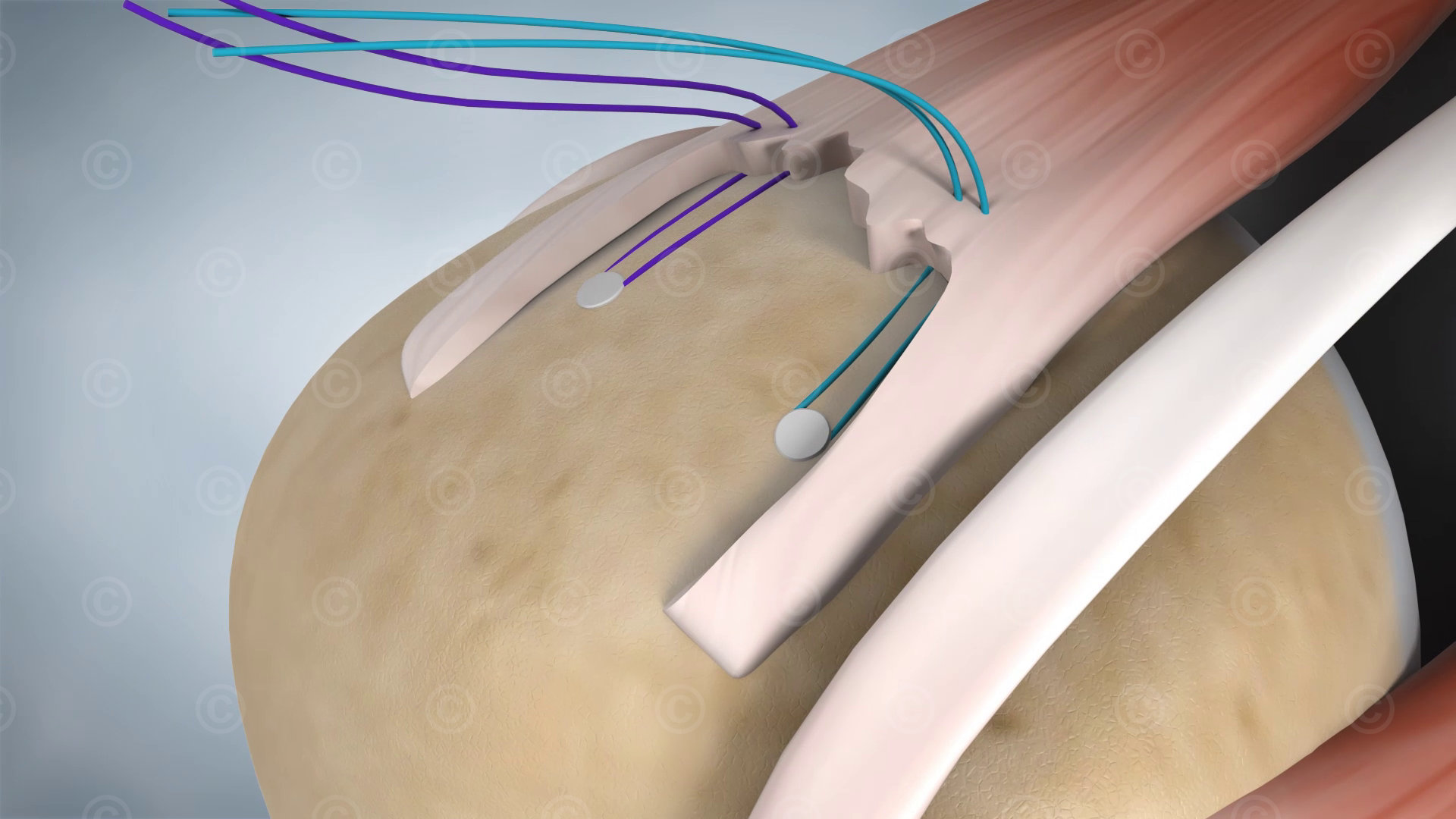 suture anchors humerus tendon