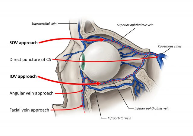 Anatomie des menschlichen Auges mit verschiedenen Zugängen zur Katheterisierung einer Karotisfistel