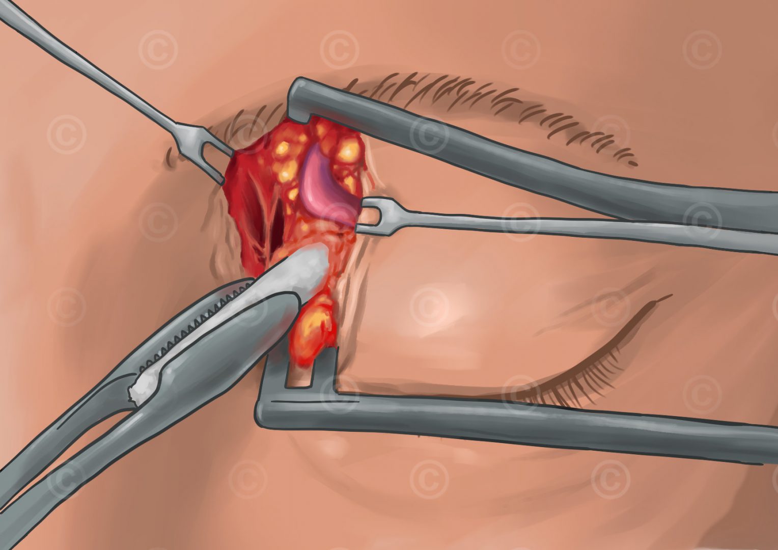 Freilegen der Vena ophthalmica superior