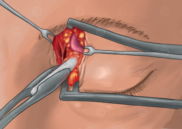 expose-vein-sov-approach