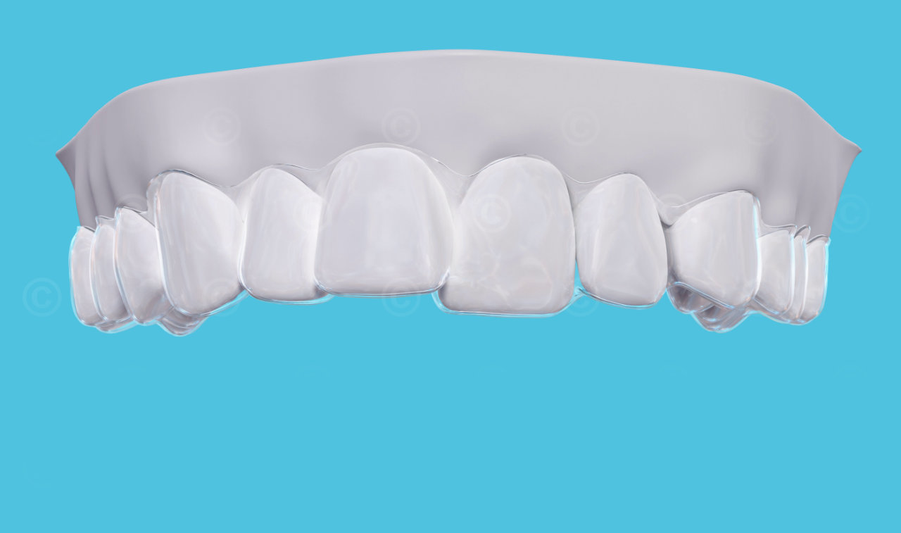 aligner-upper-jaw