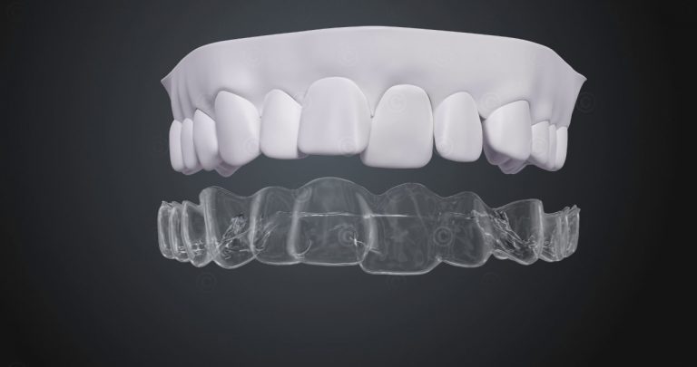 Wechsel Aligner