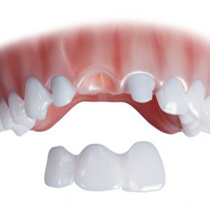 Dental bridge