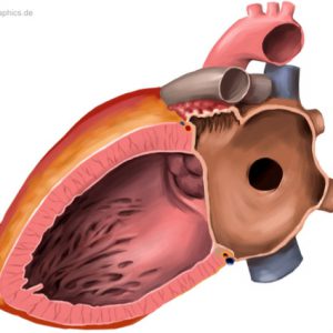 Atriumseptumdefekt
