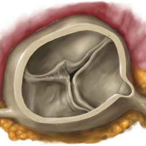 Bikuspide Aortenklappe - erworben