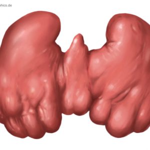 Hashimoto-Thyreoiditis
