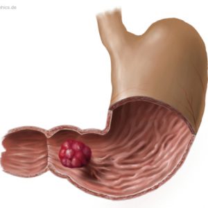 Magenpolyp