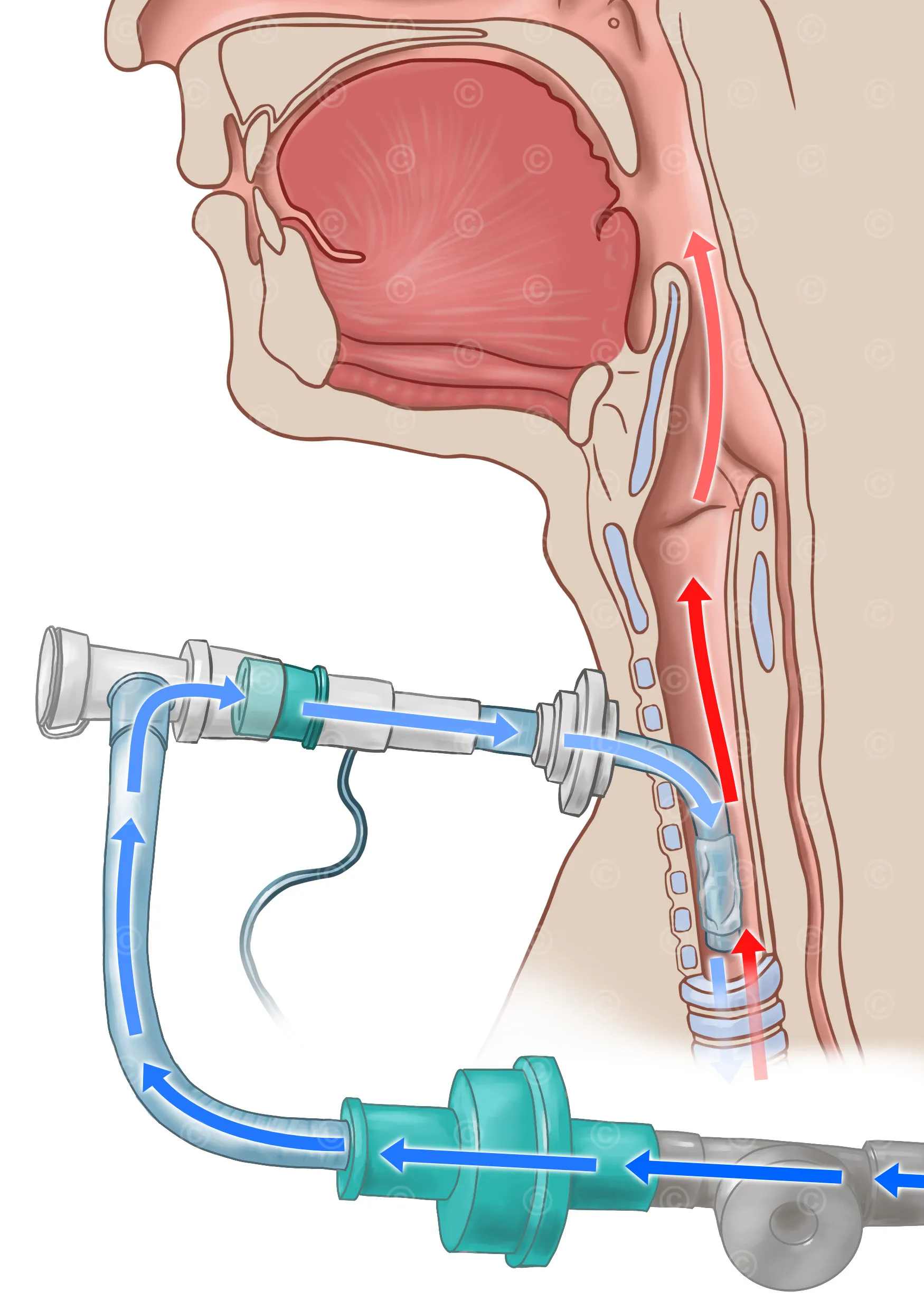 tracheostomy-speaking-valve-unblocked
