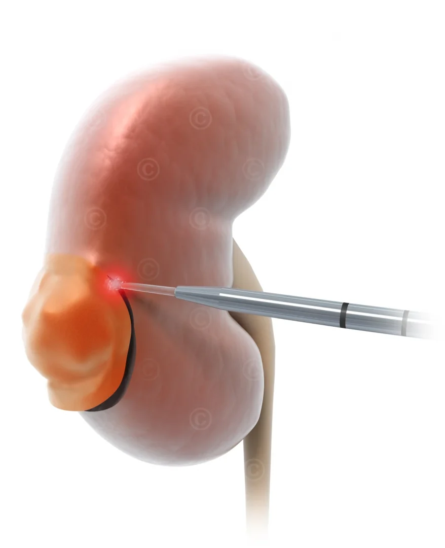 removal-renal-carcinoma