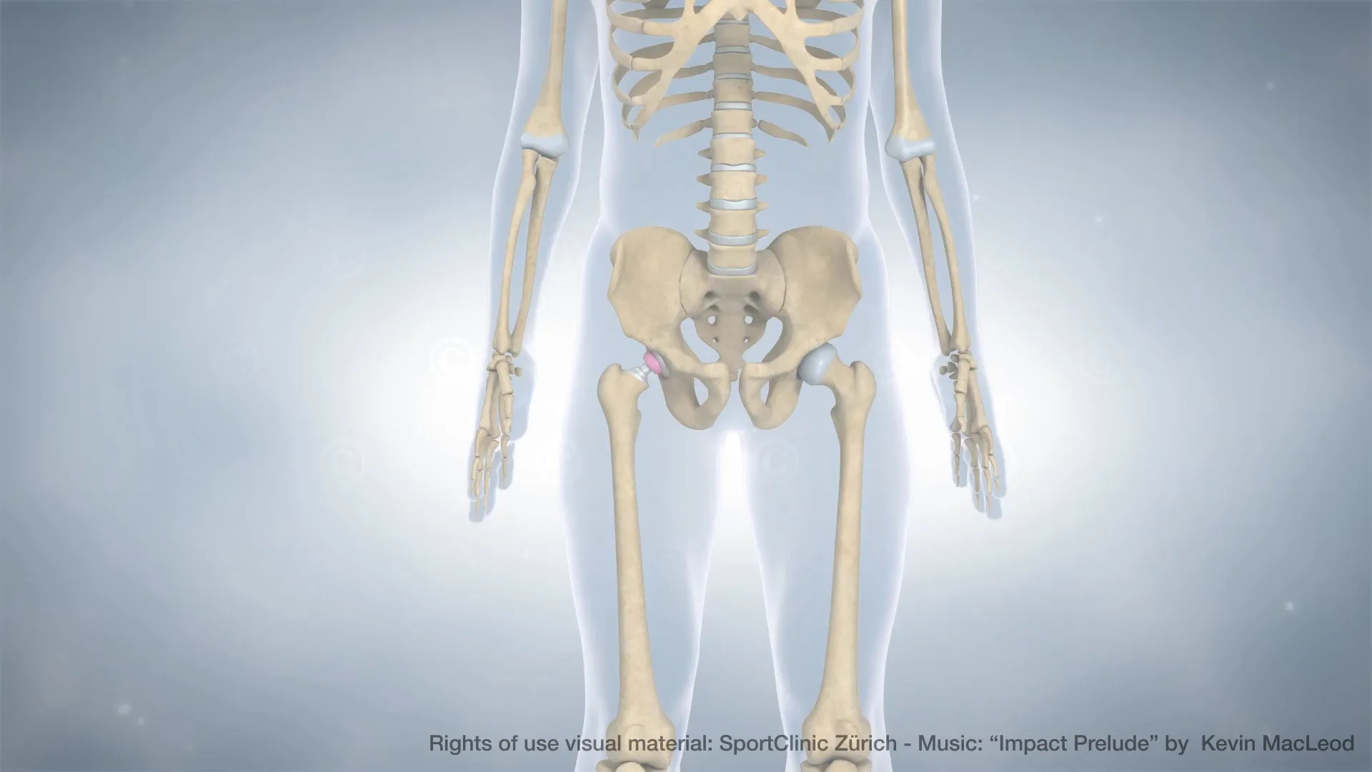 Skeleton with hip implant - total endoprosthesis