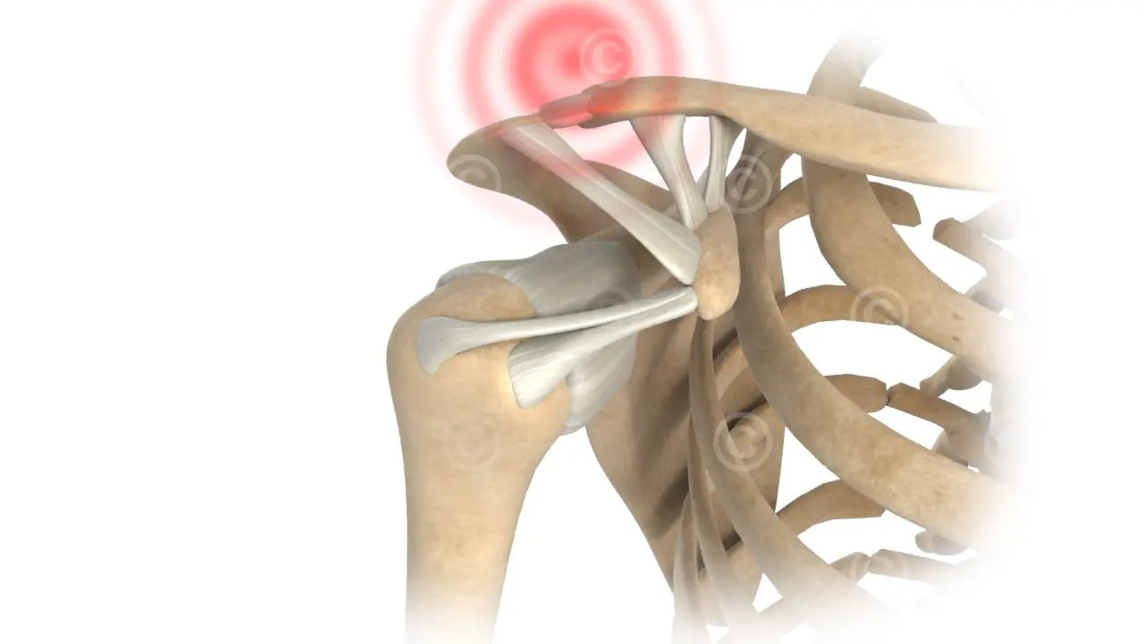 Acromioclavicular joint injury - Tossy-I