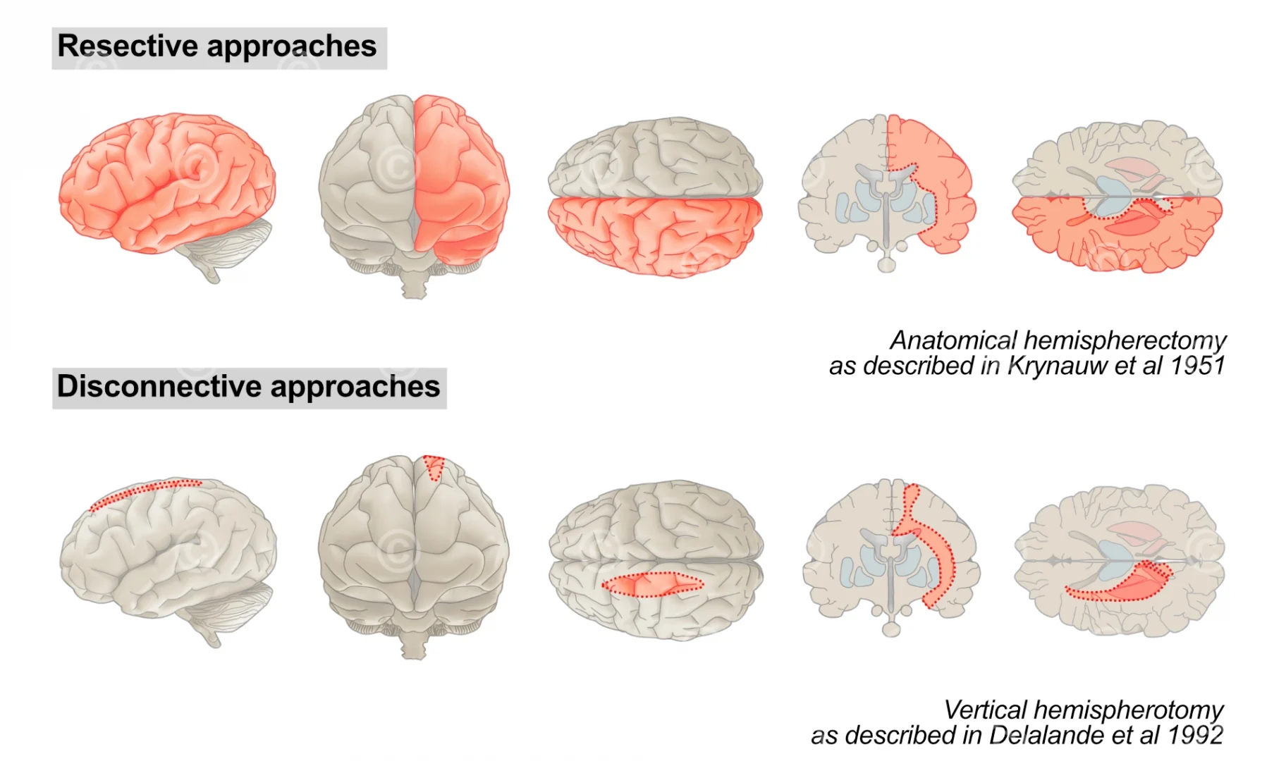 Operationsmethoden Hemisphärektomie
