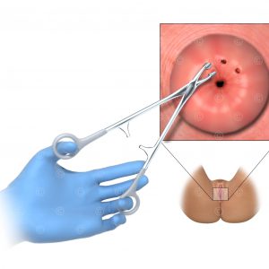 cervical-biopsy
