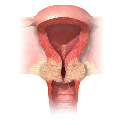 cervical-cancer-stage3
