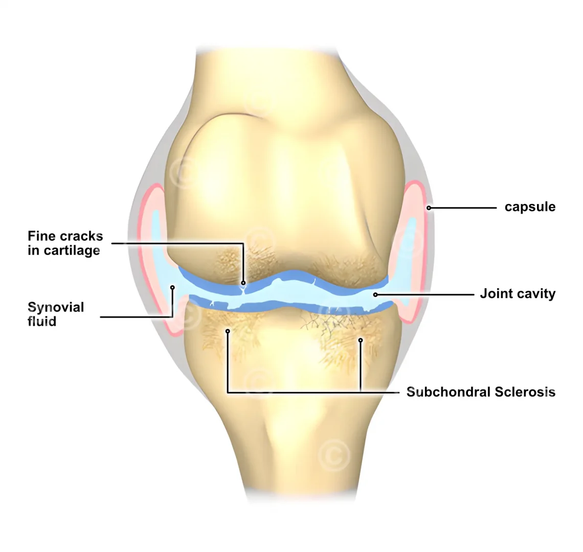 incipient-osteoarthritis-knee