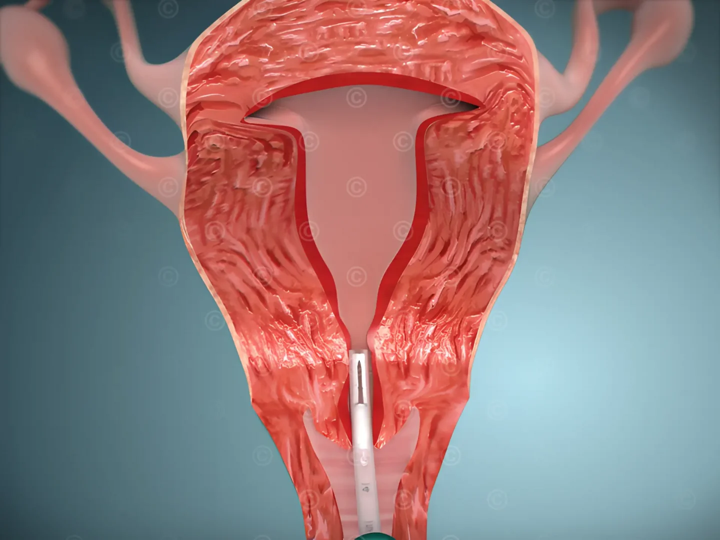 insert-hormonal-intrauterine-device-cervix