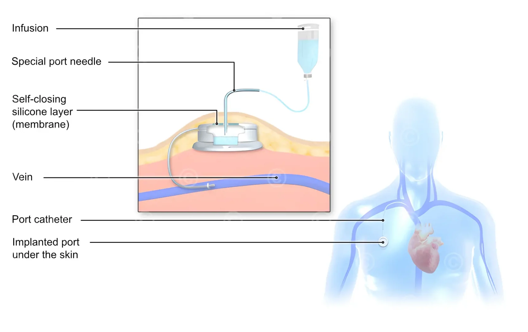 Illustration Port Catheter MedicalGraphics Illustration Port Catheter MedicalGraphics