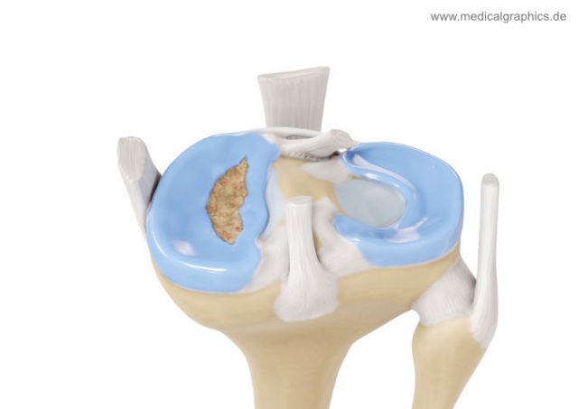 Korbhenkelriss Meniskus hinten MedicalGraphics