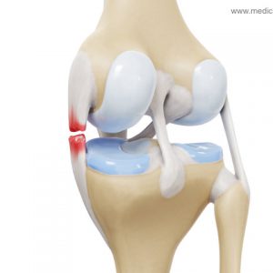 Innenbandriss Knie - seitlich hinten