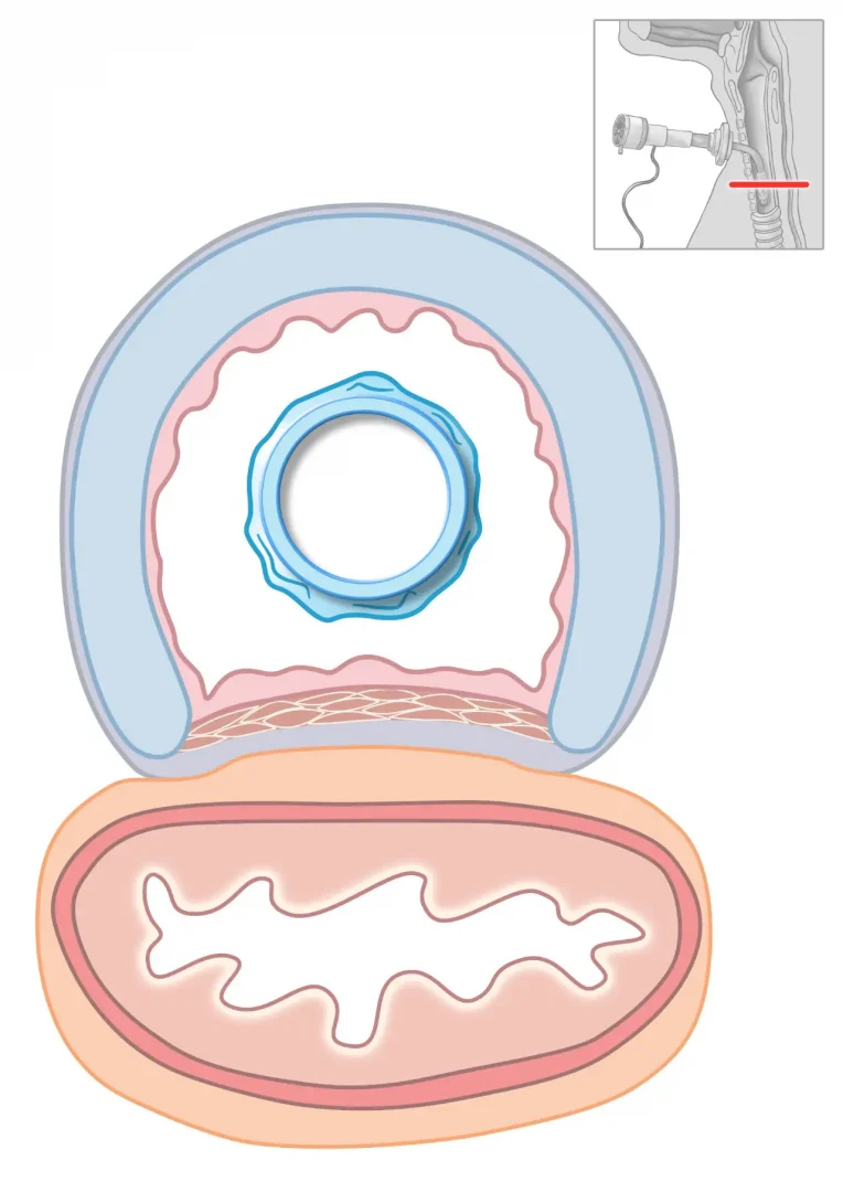 tracheal-tube-small-cross-section-uncuffed