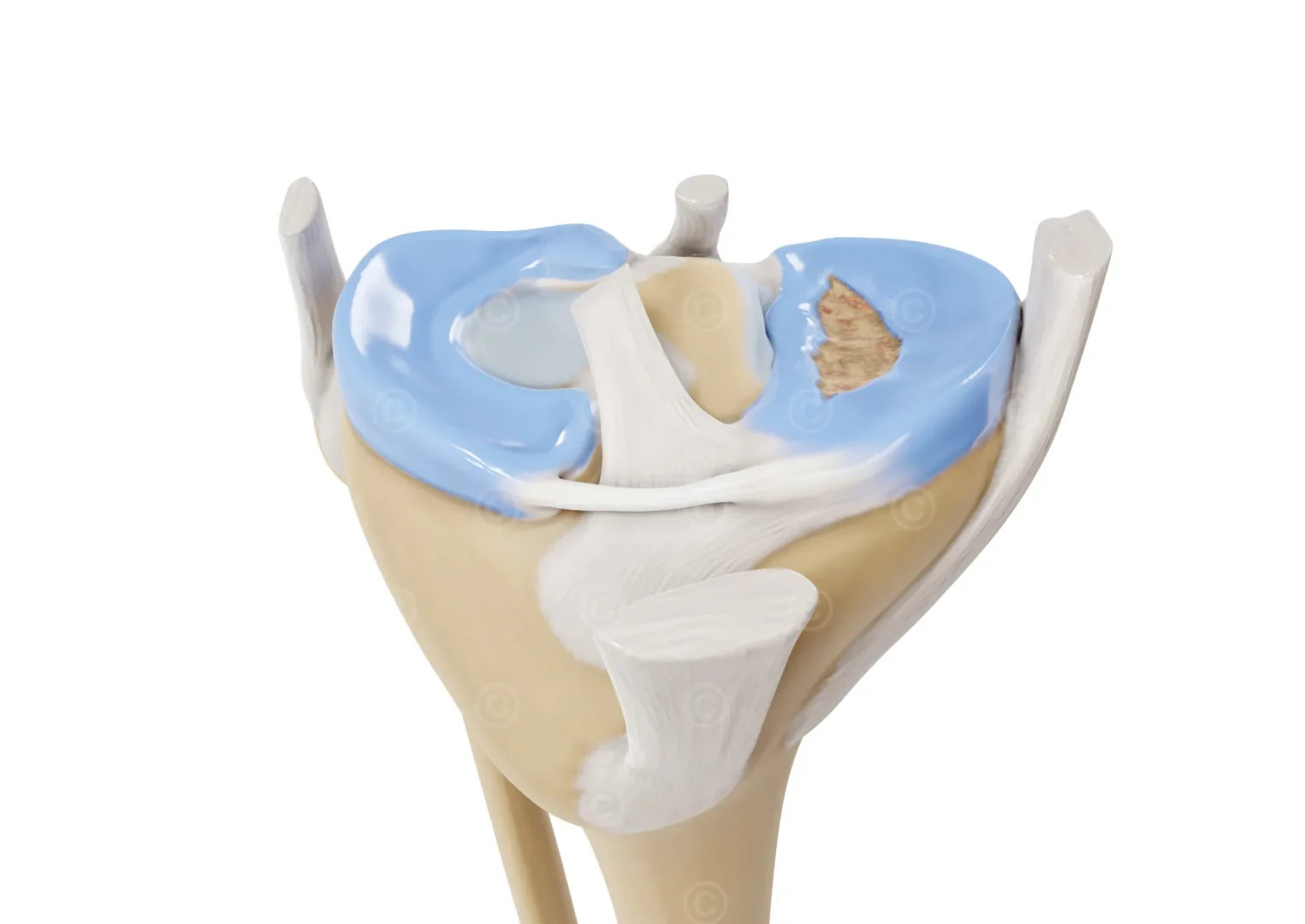 bucket-handle-tear-meniscus-front