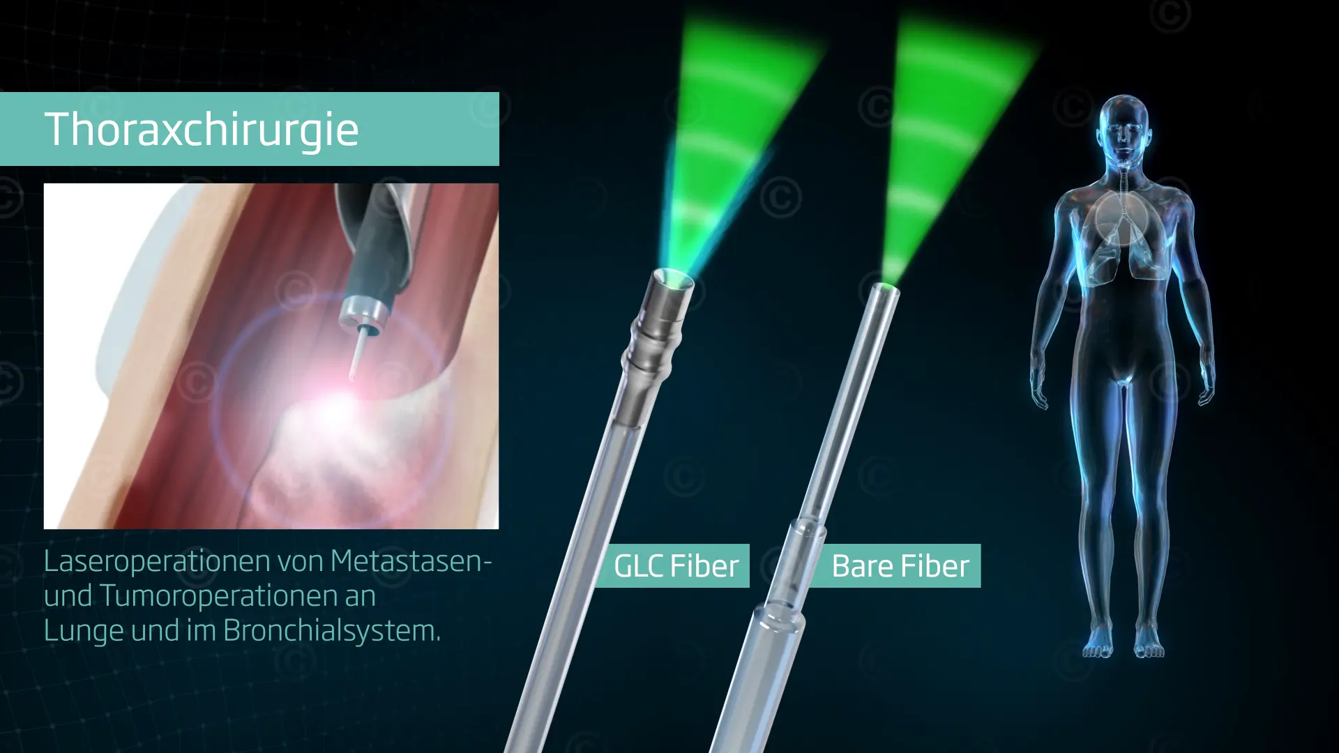 messe-animation-laser-thorax-chirurgie