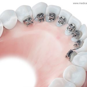 Brackets lingual - vorne