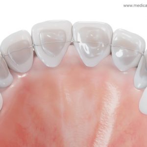 Retainer - Kieferorthopädie