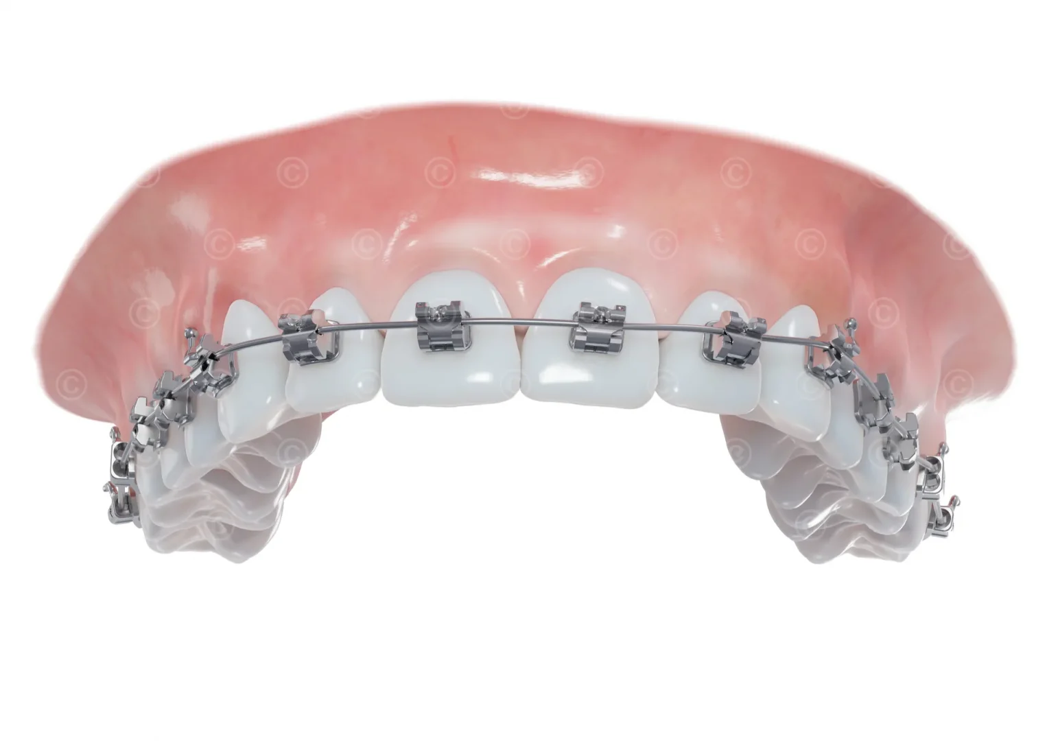 braces-upper-jaw