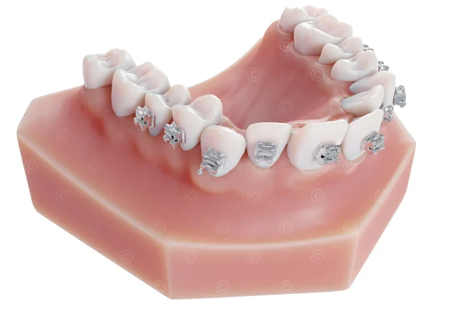 brackets-resin-model