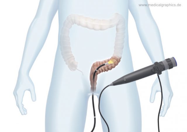 Normal Sigmoidoscopy Sigmoidoscopy - transparent human - MedicalGraphics
