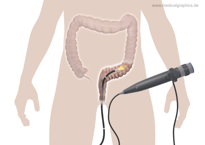 teildarmspiegelung-silhouette