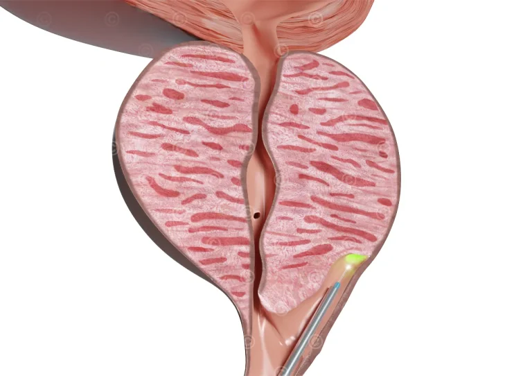 HoLEP Behandlung vergroesserte Prostata