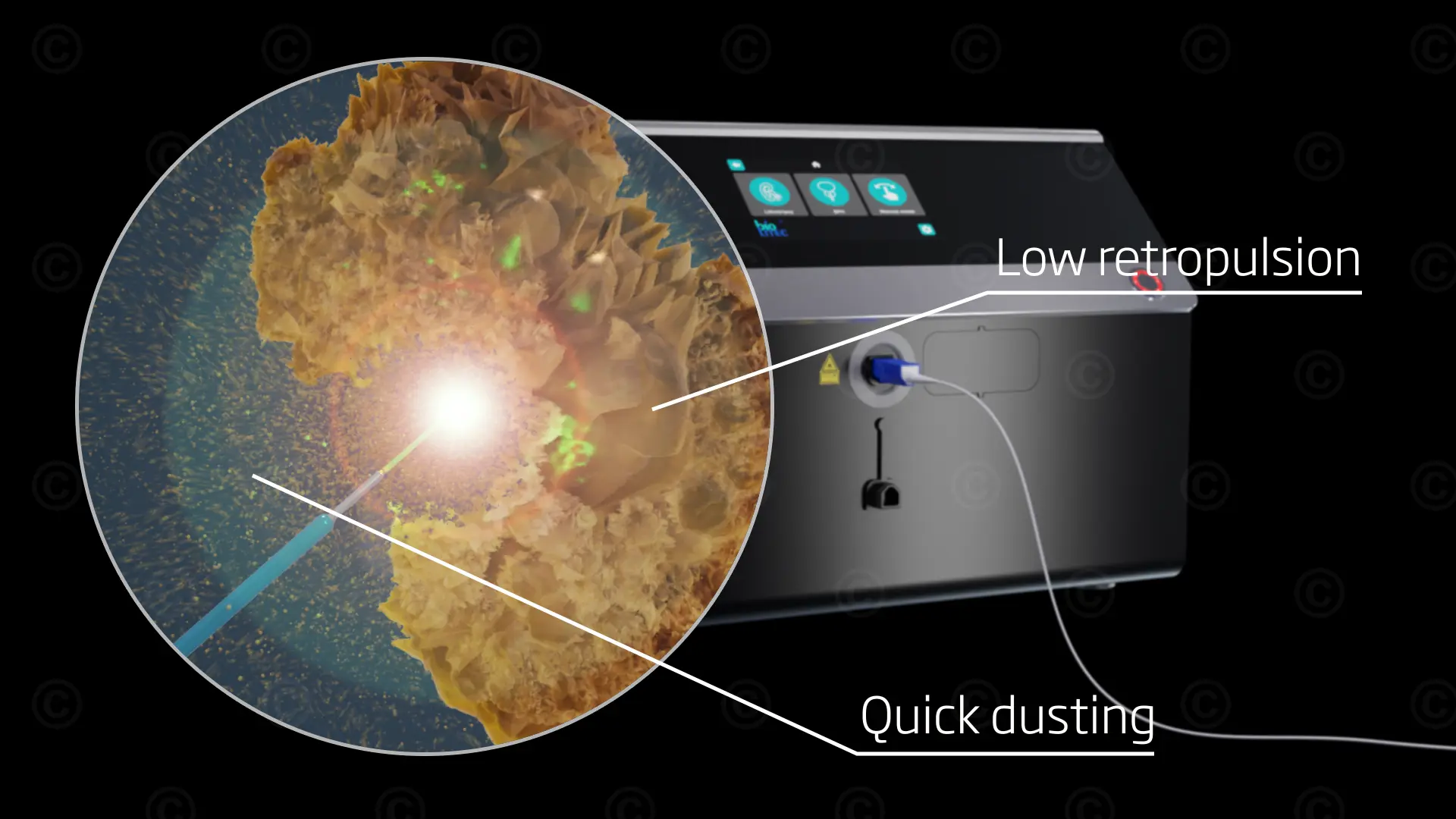 Laser lithotripsy – low recoil, rapid dissolution of kidney stones