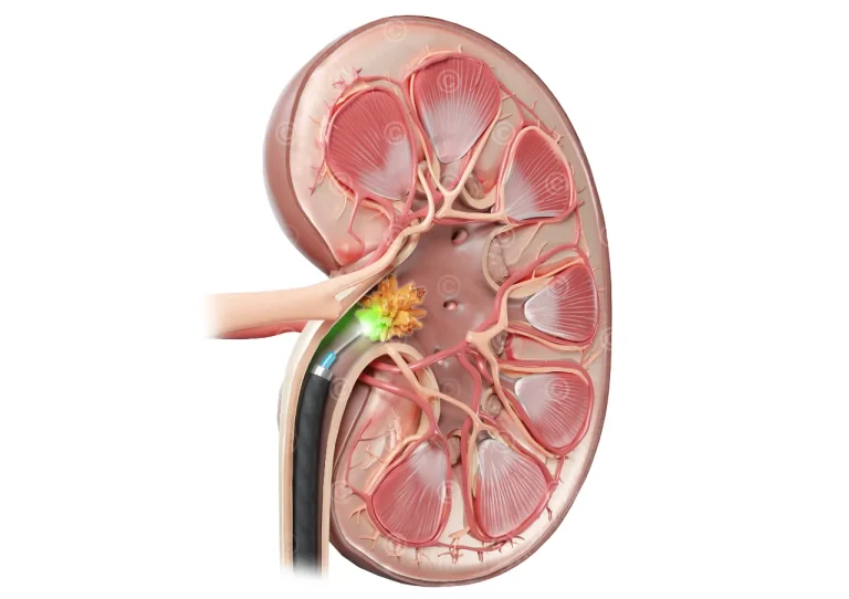Behandlung Nierenstein mittels Laser-Lithotripsie