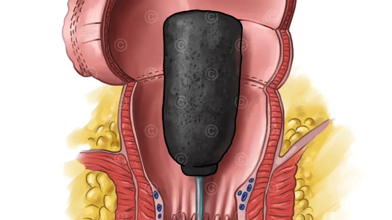 Rektum Anastomose - Endo spronge