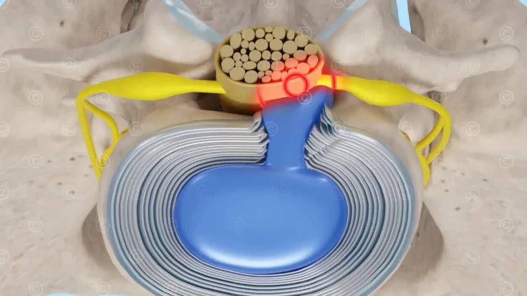 herniated disc