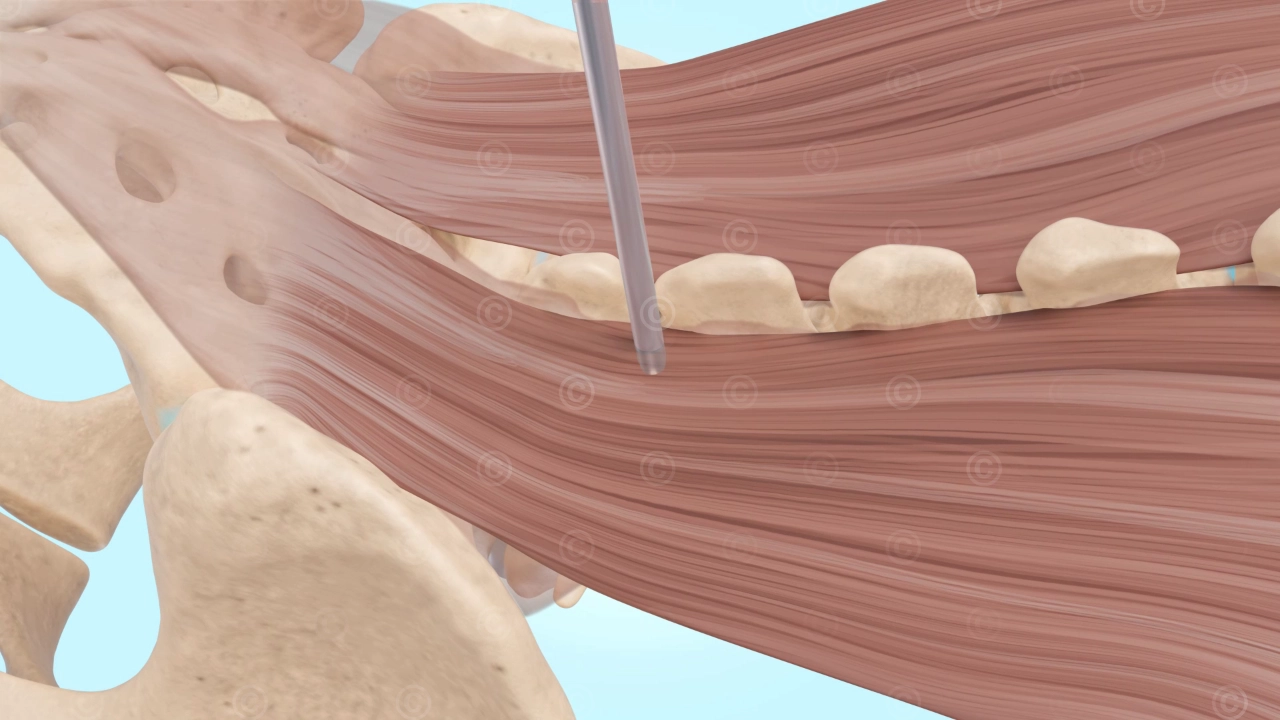 Guide rod minimally invasive spinal surgery