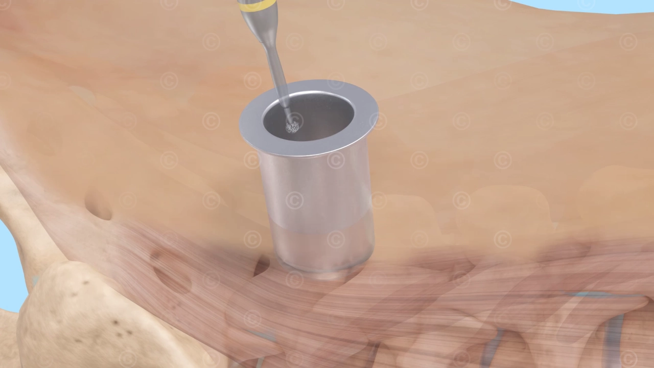 Tubus and burr - minimally invasive