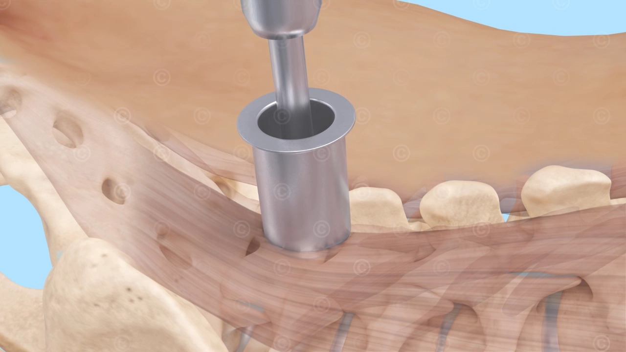 Tubular access - spine surgery