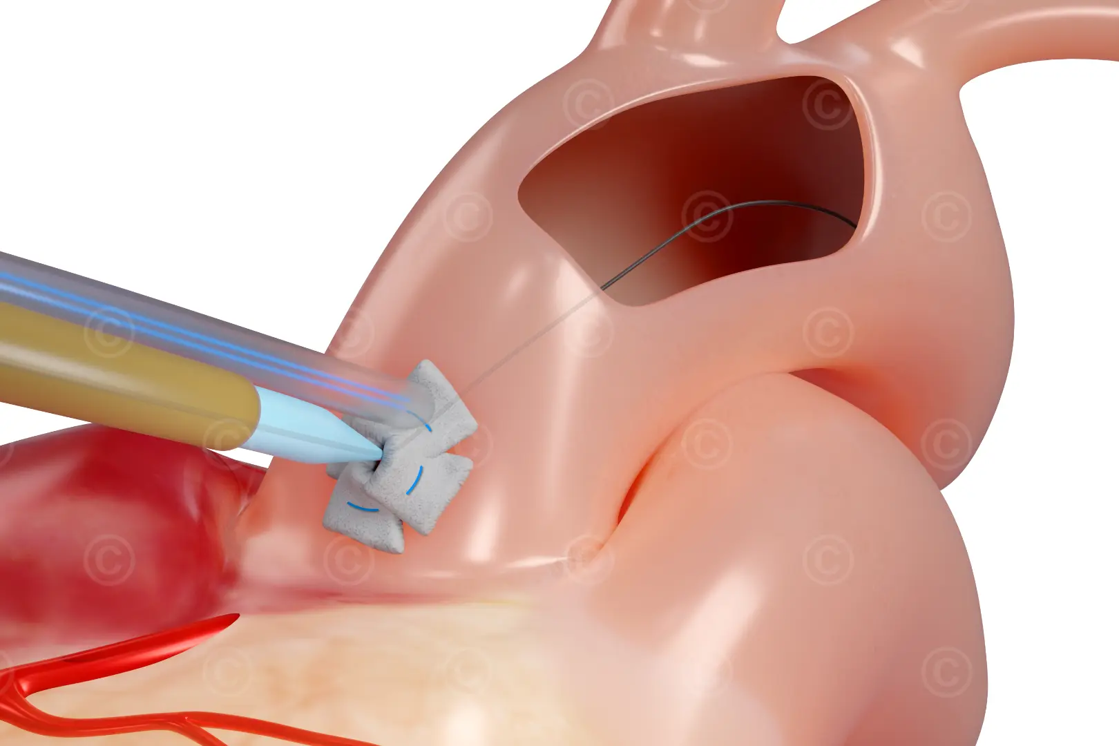 Introduction aortic canula - seldinger technique
