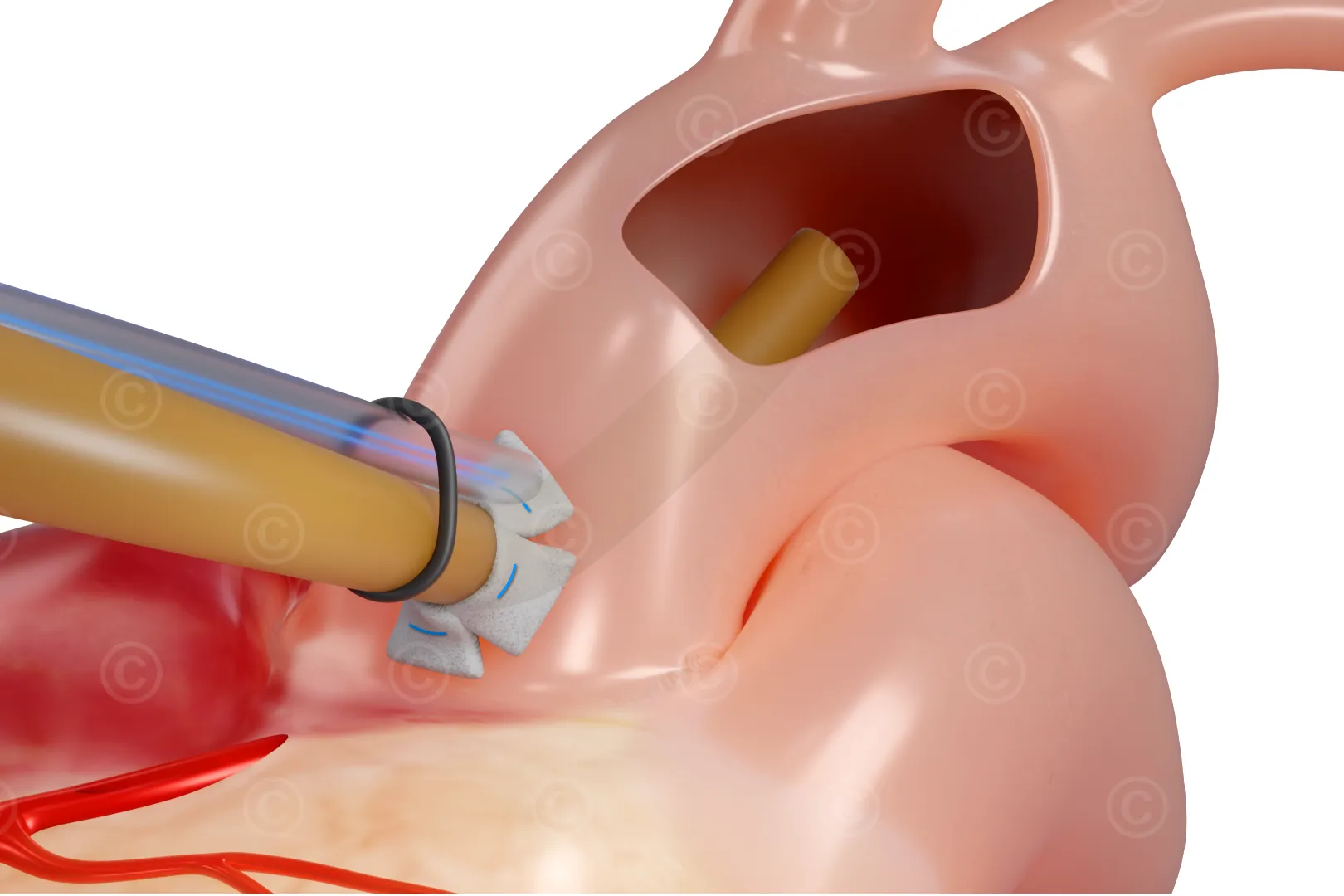 Position of canula in aortic arch - Seldinger technique