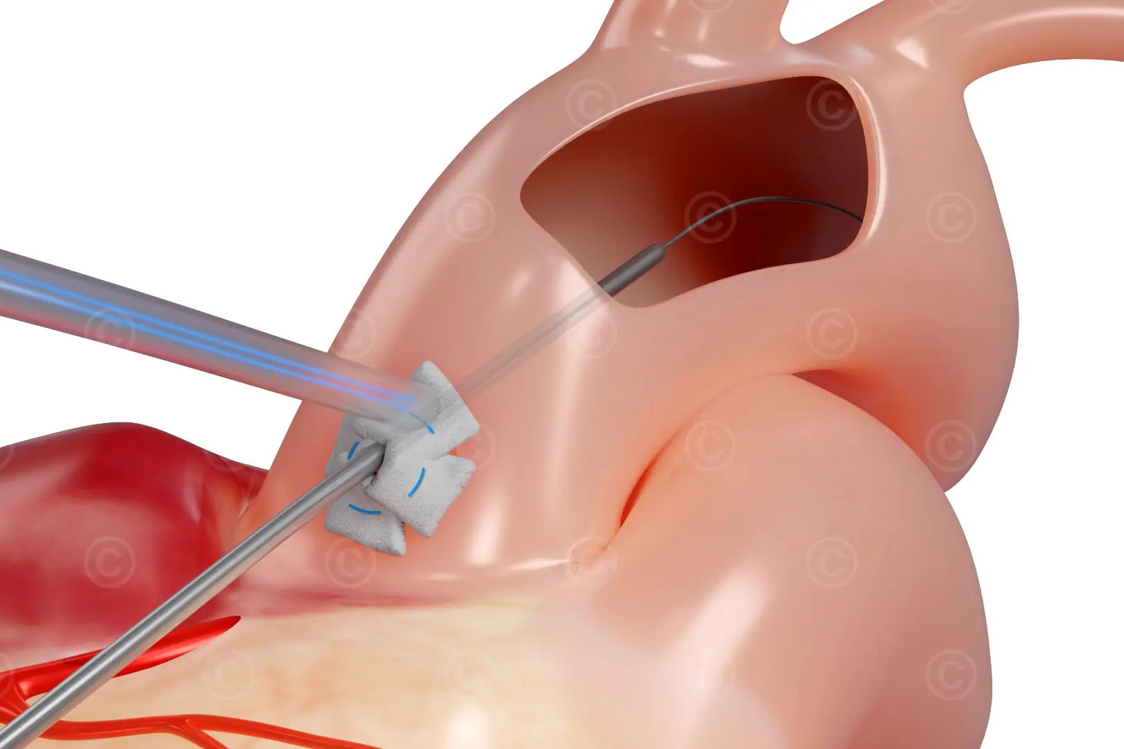 Seldinger technique - puncture and wire in aortic arch